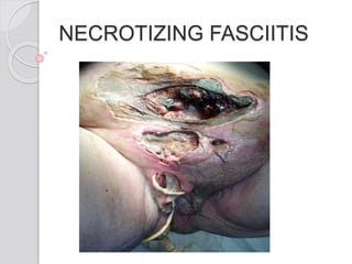 NECROTIZING FASCIITIS
 