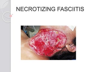 NECROTIZING FASCIITIS
 