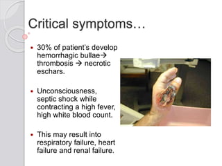 Critical symptoms…
 30% of patient’s develop
hemorrhagic bullae
thrombosis  necrotic
eschars.
 Unconsciousness,
septic shock while
contracting a high fever,
high white blood count.
 This may result into
respiratory failure, heart
failure and renal failure.
 