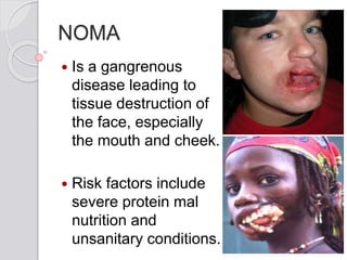 NOMA
 Is a gangrenous
disease leading to
tissue destruction of
the face, especially
the mouth and cheek.
 Risk factors include
severe protein mal
nutrition and
unsanitary conditions.
 