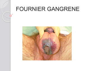 FOURNIER GANGRENE
 