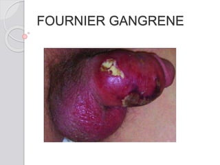 FOURNIER GANGRENE
 