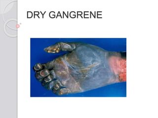 DRY GANGRENE
 