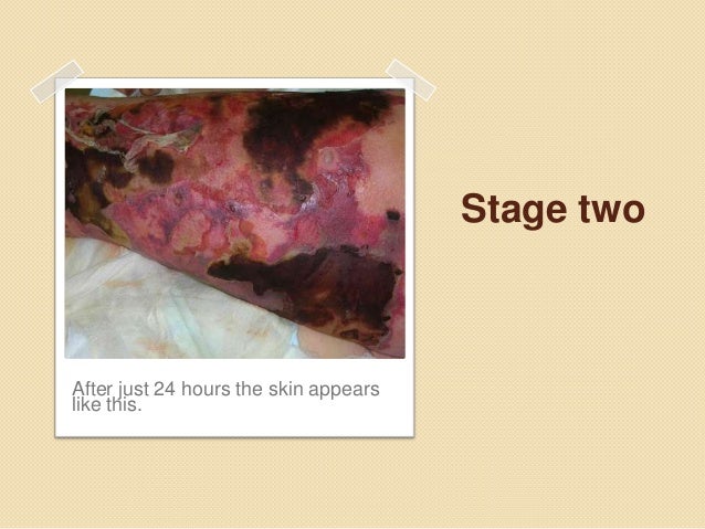 Necrotizing fasciitis (flesh eating bacteria)