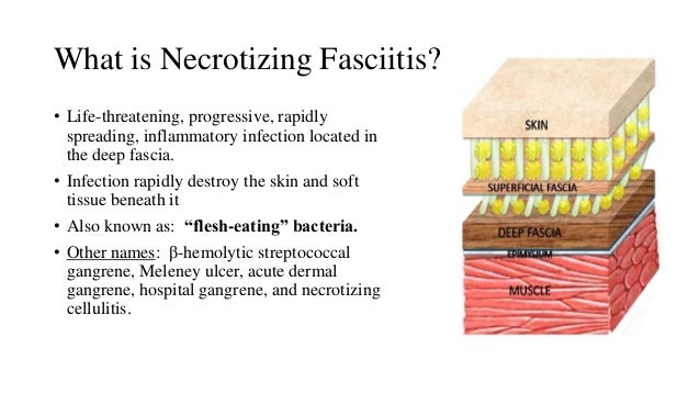 Necrotizing fascitis