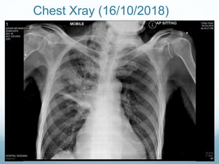Chest Xray (16/10/2018)
 