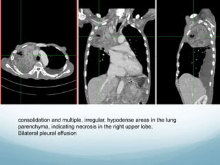 consolidation and multiple, irregular, hypodense areas in the lung
parenchyma, indicating necrosis in the right upper lobe.
Bilateral pleural effusion
 