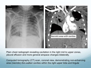 Plain chest radiograph revealing cavitation in the right mid to upper zones,
pleural effusion and more general airspace changes bilaterally.
Computed tomography (CT) scan, coronal view, demonstrating non-enhancing
area (necrotic) thin-walled cavities within the right upper lobe and lingula
 