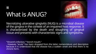 NECROTIZING ULCERATIVE GINGIVITIS in perio.pptx