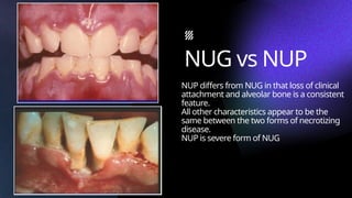 Nug Isolated NECROTIZING ULCERATIVE GINGIVITIS in perio.pptx
