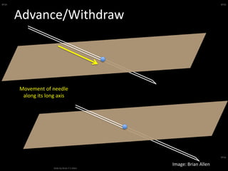 BFSA
Slide by Brian F S Allen
BFSA
BFSA
Advance/Withdraw
Movement of needle
along its long axis
Image: Brian Allen
 