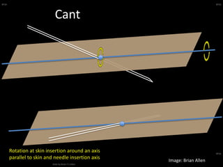 BFSA
Slide by Brian F S Allen
BFSA
BFSA
Cant
Rotation at skin insertion around an axis
parallel to skin and needle insertion axis
Image: Brian Allen
 