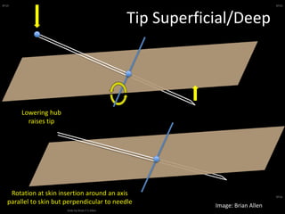BFSA
Slide by Brian F S Allen
BFSA
BFSA
Tip Superficial/Deep
Lowering hub
raises tip
Rotation at skin insertion around an axis
parallel to skin but perpendicular to needle
Image: Brian Allen
 