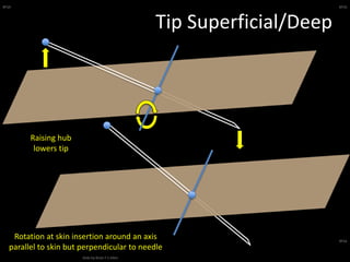 BFSA
Slide by Brian F S Allen
BFSA
BFSA
Tip Superficial/Deep
Rotation at skin insertion around an axis
parallel to skin but perpendicular to needle
Raising hub
lowers tip
 