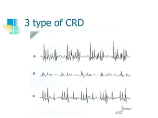 3 type of CRD
 