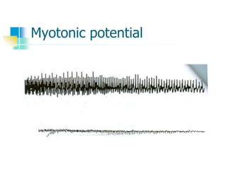 Myotonic potential
 
