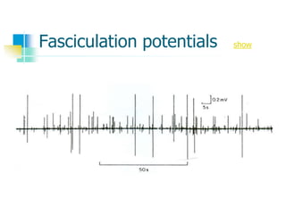 Fasciculation potentials show
 