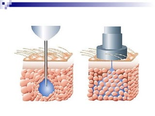 How Work Needle Free Injection Needle free injection-ppt | PPT