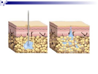 How Work Needle Free Injection Needle free injection-ppt | PPT
