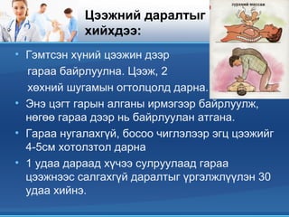 Цээжний даралтыг
хийхдээ:
• Гэмтсэн хүний цээжин дээр
гараа байрлуулна. Цээж, 2
хөхний шугамын огтолцолд дарна.
• Энэ цэгт гарын алганы ирмэгээр байрлуулж,
нөгөө гараа дээр нь байрлуулан атгана.
• Гараа нугалахгүй, босоо чиглэлээр эгц цээжийг
4-5см хотолзтол дарна
• 1 удаа дараад хүчээ сулруулаад гараа
цээжнээс салгахгүй даралтыг үргэлжлүүлэн 30
удаа хийнэ.
 