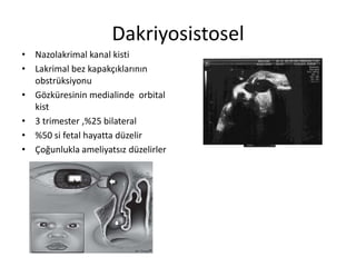 Dakriyosistosel
• Nazolakrimal kanal kisti
• Lakrimal bez kapakçıklarının
obstrüksiyonu
• Gözküresinin medialinde orbital
kist
• 3 trimester ,%25 bilateral
• %50 si fetal hayatta düzelir
• Çoğunlukla ameliyatsız düzelirler
 