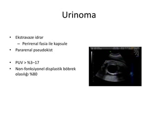 Urinoma
• Ekstravaze idrar
– Perirenal fasia ile kapsule
• Pararenal pseudokist
• PUV > %3–17
• Non-fonksiyonel displastik böbrek
olasılığı %80
 