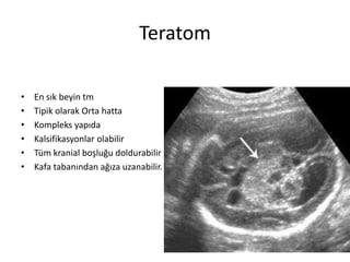 Teratom
• En sık beyin tm
• Tipik olarak Orta hatta
• Kompleks yapıda
• Kalsifikasyonlar olabilir
• Tüm kranial boşluğu doldurabilir
• Kafa tabanından ağıza uzanabilir.
 