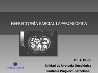 Dr. J. Palou Unidad de Urología Oncológica Fundació Puigvert. Barcelona.  NEFRECTOMÍA PARCIAL LAPAROSCÓPICA 