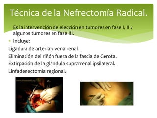  Es la intervención de elección en tumores en fase I, II y
algunos tumores en fase III.
 Incluye:
Ligadura de arteria y vena renal.
Eliminación del riñón fuera de la fascia de Gerota.
Extirpación de la glándula suprarrenal ipsilateral.
Linfadenectomía regional.
Técnica de la Nefrectomía Radical.
 