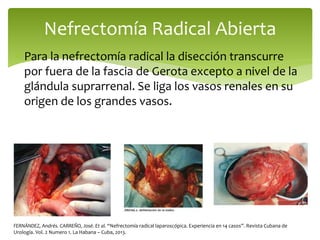  Para la nefrectomía radical la disección transcurre
por fuera de la fascia de Gerota excepto a nivel de la
glándula suprarrenal. Se liga los vasos renales en su
origen de los grandes vasos.
Nefrectomía Radical Abierta
FERNÁNDEZ, Andrés. CARREÑO, José. Et al. “Nefrectomía radical laparoscópica. Experiencia en 14 casos”. Revista Cubana de
Urología. Vol. 2 Numero 1. La Habana – Cuba, 2013.
 