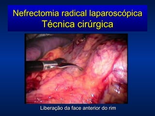Liberação da face anterior do rim Nefrectomia radical laparoscópica Técnica cirúrgica 