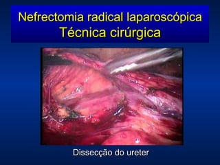 Dissecção do ureter Nefrectomia radical laparoscópica Técnica cirúrgica 