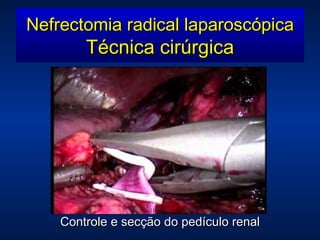 Controle e secção do pedículo renal Nefrectomia radical laparoscópica Técnica cirúrgica 