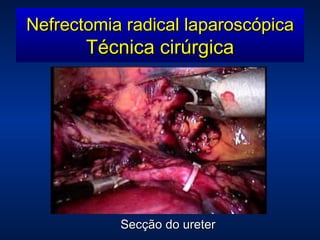 Secção do ureter Nefrectomia radical laparoscópica Técnica cirúrgica 