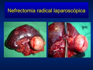 Nefrectomia radical laparoscópica 
