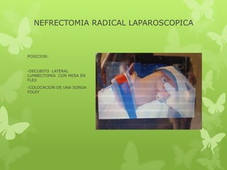 NEFRECTOMIA RADICAL LAPAROSCOPICA



POSICION:


-DECUBITO LATERAL
LUMBECTOMIA CON MESA EN
FLEX
-COLOCACION DE UNA SONDA
FOLEY
 