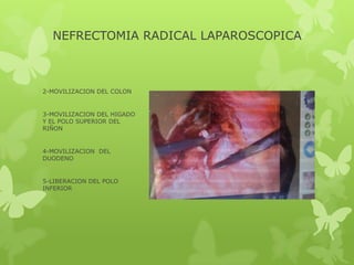 NEFRECTOMIA RADICAL LAPAROSCOPICA



2-MOVILIZACION DEL COLON


3-MOVILIZACION DEL HIGADO
Y EL POLO SUPERIOR DEL
RIÑON


4-MOVILIZACION DEL
DUODENO


5-LIBERACION DEL POLO
INFERIOR
 