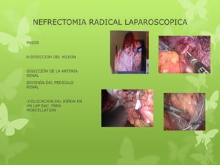 NEFRECTOMIA RADICAL LAPAROSCOPICA

PASOS


6-DISECCION DEL HILEON


DISECCIÓN DE LA ARTERIA
RENAL
DIVISIÓN DEL PEDÍCULO
RENAL


-COLOCACION DEL RIÑON EN
UN LAP SAC PARA
MORCELLATION
 