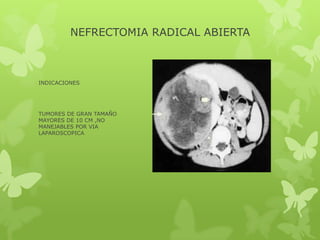 NEFRECTOMIA RADICAL ABIERTA



INDICACIONES




TUMORES DE GRAN TAMAÑO
MAYORES DE 10 CM ,NO
MANEJABLES POR VIA
LAPAROSCOPICA
 