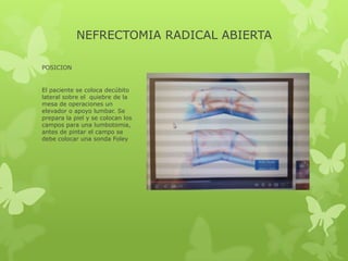 NEFRECTOMIA RADICAL ABIERTA

POSICION


El paciente se coloca decúbito
lateral sobre el quiebre de la
mesa de operaciones un
elevador o apoyo lumbar. Se
prepara la piel y se colocan los
campos para una lumbotomia,
antes de pintar el campo se
debe colocar una sonda Foley
 
