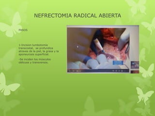 NEFRECTOMIA RADICAL ABIERTA

PASOS




1-Incision lumbotomía
transcostal, se profundiza
atraves de la piel, la grasa y la
aponeurosis superficial.
-Se inciden los músculos
oblicuos y transversos.
 