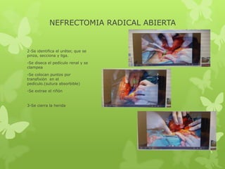 NEFRECTOMIA RADICAL ABIERTA


2-Se identifica el uréter, que se
pinza, secciona y liga.
-Se diseca el pedículo renal y se
clampea
-Se colocan puntos por
transfixión en el
pedículo.(sutura absorbible)
-Se extrae el riñón


3-Se cierra la herida
 