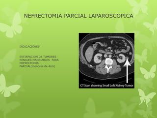NEFRECTOMIA PARCIAL LAPAROSCOPICA




INDICACIONES


EXTIRPACION DE TUMORES
RENALES MANEJABLES PARA
NEFRECTOMIA
PARCIAL(menores de 4cm)
 