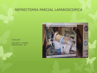 NEFRECTOMIA PARCIAL LAPAROSCOPICA




POSICION
DECUBITO LATERAL
MODIFICADO 30°
 