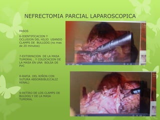 NEFRECTOMIA PARCIAL LAPAROSCOPICA

PASOS
6-IDENTIFICACION Y
OCLUSION DEL HILIO USANDO
CLAMPS DE BULLGOG (no mas
de 20 minutos)


7-EXTIRPACION DE LA MASA
TUMORAL , Y COLOCACION DE
LA MASA EN UNA BOLSA DE
PVC


8-RAFIA DEL RIÑON CON
SUTURA ABSORBIBLE(CALIZ
RENAL)


9-RETIRO DE LOS CLAMPS DE
BULDOG Y DE LA MASA
TUMORAL
 
