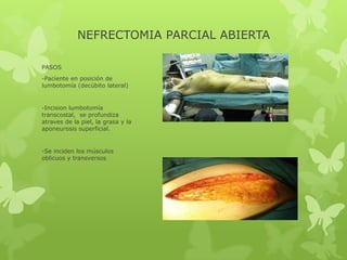 NEFRECTOMIA PARCIAL ABIERTA

PASOS
-Paciente en posición de
lumbotomía (decúbito lateral)


-Incision lumbotomía
transcostal, se profundiza
atraves de la piel, la grasa y la
aponeurosis superficial.


-Se inciden los músculos
oblicuos y transversos
 