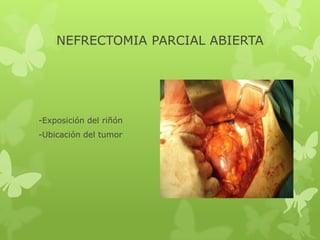 NEFRECTOMIA PARCIAL ABIERTA




-Exposición del riñón
-Ubicación del tumor
 