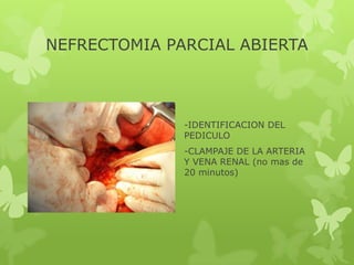 NEFRECTOMIA PARCIAL ABIERTA



              -IDENTIFICACION DEL
              PEDICULO
              -CLAMPAJE DE LA ARTERIA
              Y VENA RENAL (no mas de
              20 minutos)
 