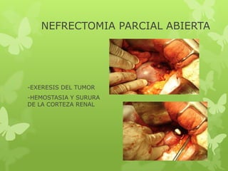 NEFRECTOMIA PARCIAL ABIERTA




-EXERESIS DEL TUMOR
-HEMOSTASIA Y SURURA
DE LA CORTEZA RENAL
 