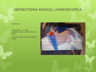 NEFRECTOMIA RADICAL LAPAROSCOPICA



POSICION:


-DECUBITO LATERAL
LUMBECTOMIA CON MESA EN
FLEX
-COLOCACION DE UNA SONDA
F...